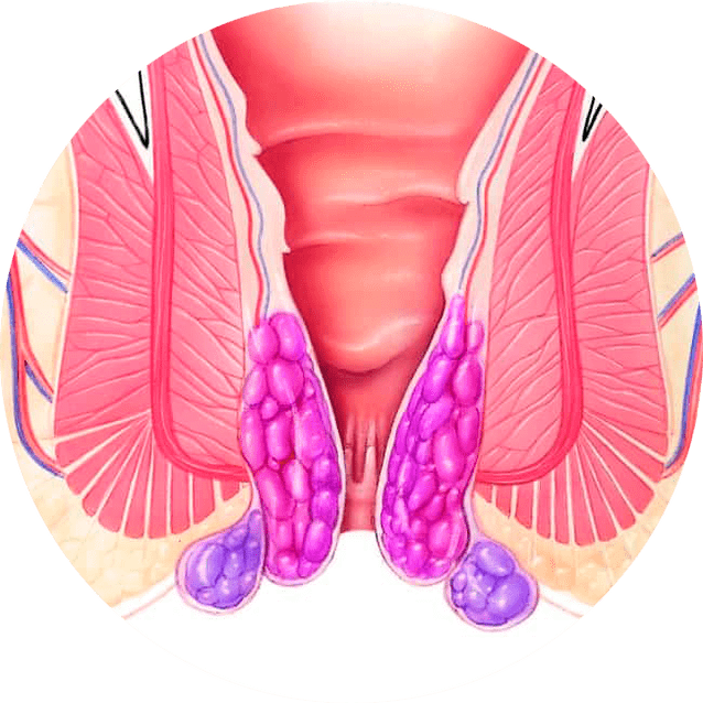 Gelarex lindert Symptomer vun der éischter Benotzung